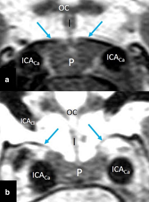 The diaphragma sellae, diaphragm opening, and subdiaphragmatic cistern: an  anatomical study using magnetic resonance imaging | Surgical and Radiologic  Anatomy