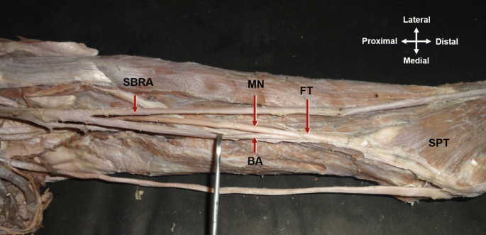 Coexistence of variant pronator teres muscle and variant course of the  neurovascular structures in the arm: clinical significance | Surgical and  Radiologic Anatomy