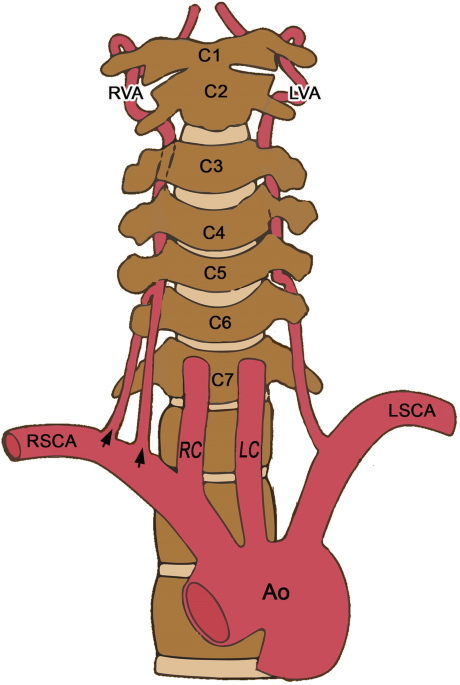 A–D) The spontaneous fusion between C2 and C3 and a br