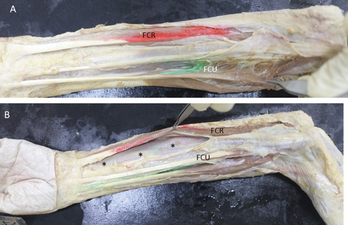 Compartments of the antebrachial fascia of the forearm: clinically relevant  ultrasound, anatomical and histological findings | Surgical and Radiologic  Anatomy