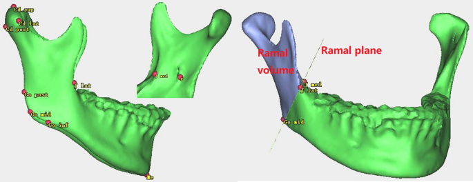 Prevalence of medial depression of the mandibu- lar ramus (MDMR) in the