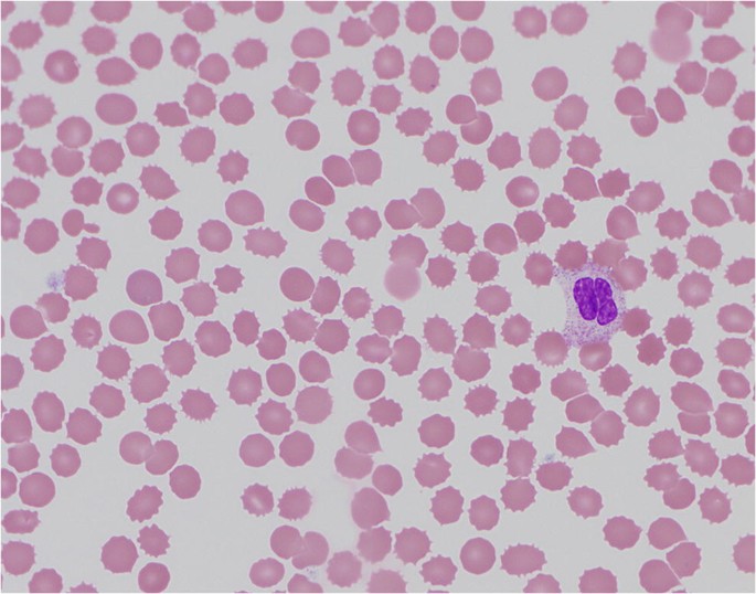 Isolated severe thrombocytopenia in the setting of extreme hyperthermia |  Annals of Hematology