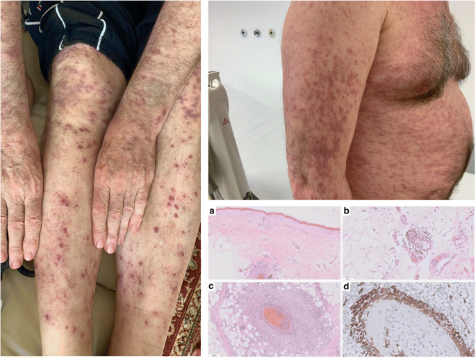 Skin changes in hairy cell leukemia | Annals of Hematology