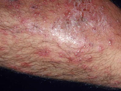 Skin Infections Caused by Staphylococcus aureus, HTML