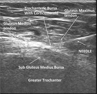 Greater Trochanteric Bursitis - Excel Spine