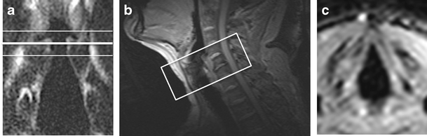 Feasibility of vocal fold abduction and adduction assessment using cine-MRI  | European Radiology