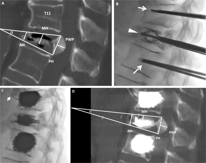 Vertebral augmentation with the SpineJack® in chronic vertebral