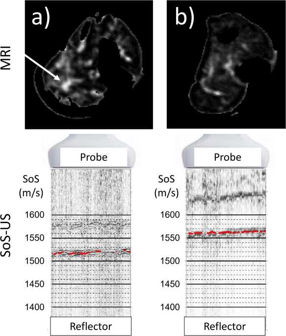 A-mode and B-mode ultrasound measurement of fat thickness: a cadaver  validation study