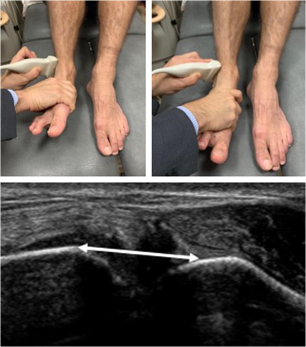 PDF] Update on acute ankle sprains.
