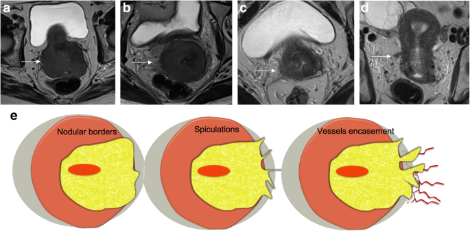 Staging, recurrence and follow-up of uterine cervical cancer using MRI:  Updated Guidelines of the European Society of Urogenital Radiology after  revised FIGO staging 2018 | European Radiology