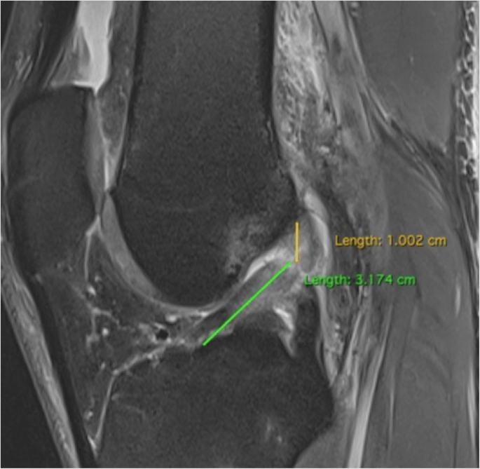Primary anterior cruciate ligament repair: magnetic resonance