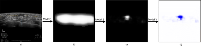 Automated breast ultrasound system (ABUS): can it replace mammography as a  screening tool?, Egyptian Journal of Radiology and Nuclear Medicine