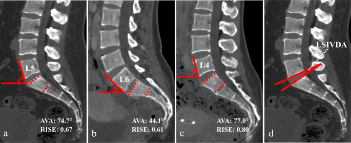 Intervertebral disc angles and the lumbar-sacral junction