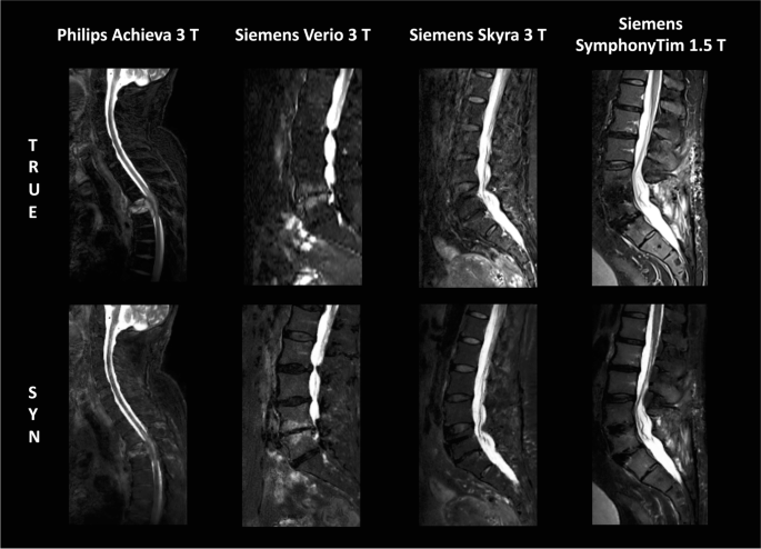 Synthetic T2-weighted fat sat based on a generative adversarial network  shows potential for scan time reduction in spine imaging in a multicenter  test dataset | European Radiology