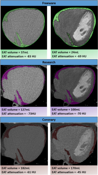 Inter-software and inter-scan variability in measurement of epicardial  adipose tissue: a three-way comparison of a research-specific, a freeware  and a coronary application software platform | European Radiology