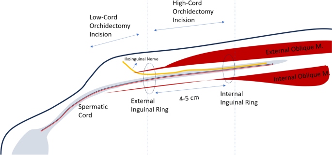 Low-cord orchidectomy for testicular cancer: what would be different?