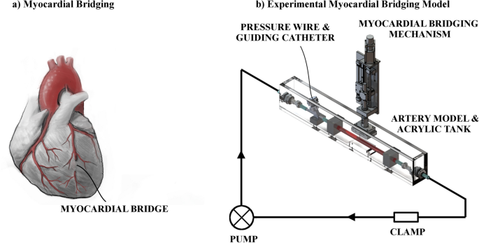 Update on Myocardial Bridging