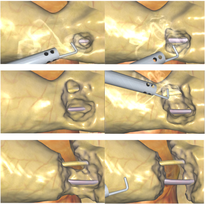 Real-time simulation of electrocautery procedure using meshfree methods in  laparoscopic cholecystectomy