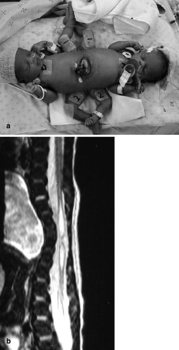 Ischiopagus and pygopagus conjoined twins: neurosurgical considerations |  Child's Nervous System