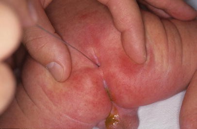 Cutaneous lesions in occult spinal dysraphism—correlation with intraspinal  findings | Child's Nervous System