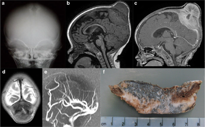 melanotic neuroectodermal tumor of infancy radiology tumour infancy, a rare cause for a bump on the head | Child's Nervous System Chemotherapy