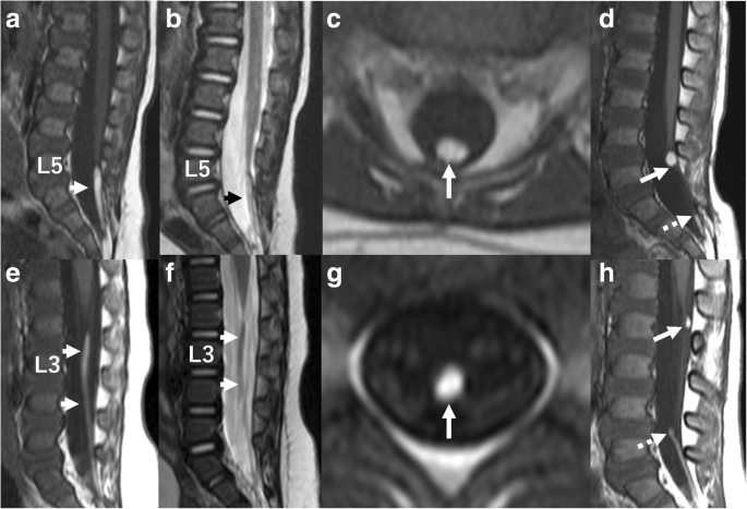 Familial tendency in patients with lipoma of the filum terminale | Child's  Nervous System