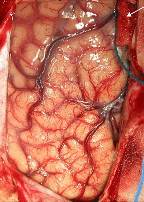 Outcomes and surgical approaches for pineal region tumors in children: 30  years' experience in: Journal of Neurosurgery: Pediatrics Volume 32 Issue 2  (2023) Journals