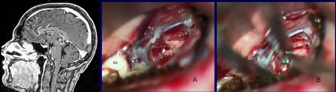 Outcomes and surgical approaches for pineal region tumors in children: 30  years' experience in: Journal of Neurosurgery: Pediatrics Volume 32 Issue 2  (2023) Journals