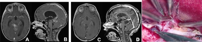 Outcomes and surgical approaches for pineal region tumors in children: 30  years' experience in: Journal of Neurosurgery: Pediatrics Volume 32 Issue 2  (2023) Journals