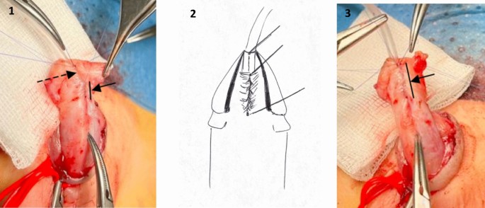 Incidence of urethrocutaneous fistula after distal and midshaft hypospadias repair does not differ among patients treated with or without a protective second-layer: single tertiary centre experience