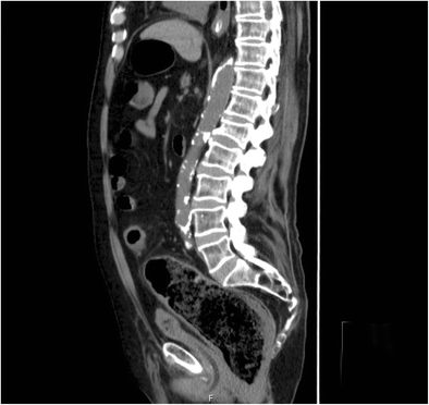 Fecal impaction, Radiology Reference Article