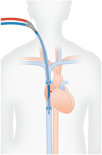 Cannulation strategies for percutaneous extracorporeal membrane oxygenation  in adults | Clinical Research in Cardiology
