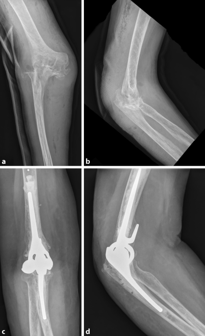 Ellenbogenprothese bei rheumatischen Erkrankungen | Zeitschrift fr  Rheumatologie | Springer Nature Link