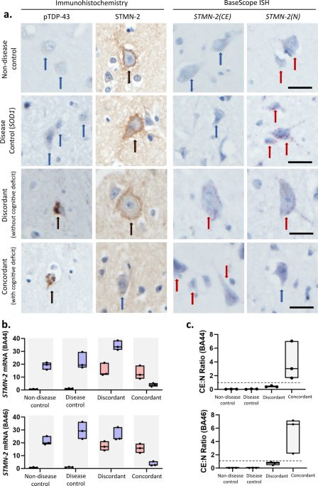 RNA aptamer reveals nuclear TDP-43 pathology is an early aggregation event that coincides with STMN-2 cryptic splicing and precedes clinical manifestation in ALS