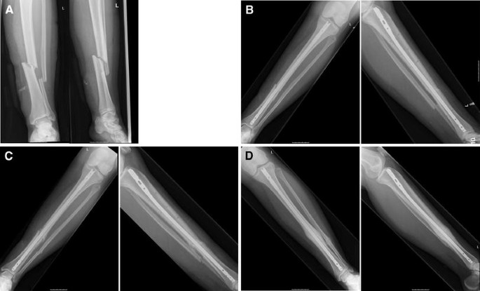 Tibial intramedullary nail - 14000-08270 - Medimetal - titanium / stainless  steel