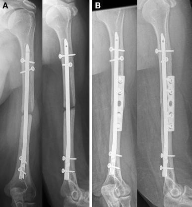 Is intramedullary nailing superior to plating in patients with  extraarticular fracture of the distal tibia? - Medwave