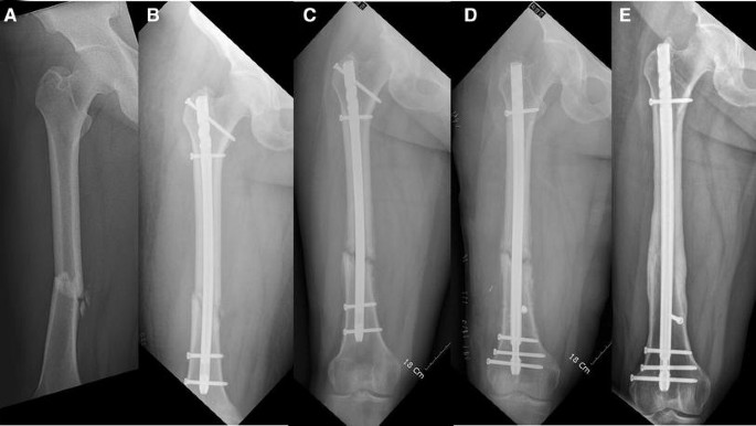 A comparative study of intramedullary interlocking nailing and minimally  invasive plate osteosynthesis in extra articular distal tibial fractures |  Semantic Scholar