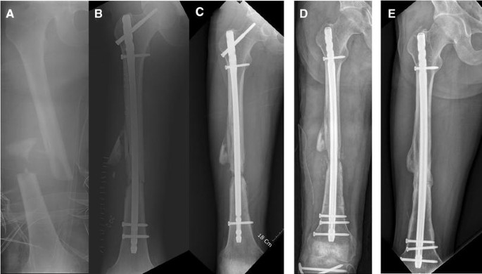 Clinical outcomes of femoral shaft non-union: dual plating versus exchange  nailing with augmentation plating | Journal of Orthopaedic Surgery and  Research | Full Text