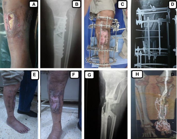 Full ring external fixation (Ilizarov) for Extraarticular, wedge