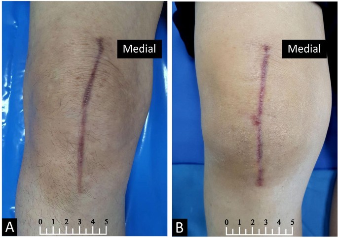 Cureus, A Comparative Study Between Conventional Sutures, Staples, and Adhesive  Glue for Clean Elective Surgical Skin Closure