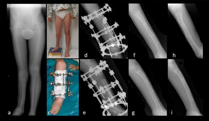 Full-ring Ilizarov frame applied for lengthening of tibia.