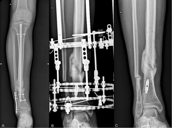 Llizarov Tibia Ring External Fixator Lengthening for Delayed, time ring  tibia - thirstymag.com
