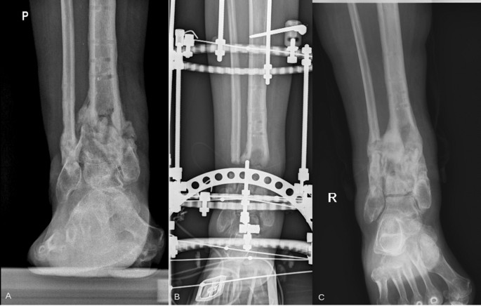 Orthopedic Fixation Ilizarov Ring External Fixator for Tibia