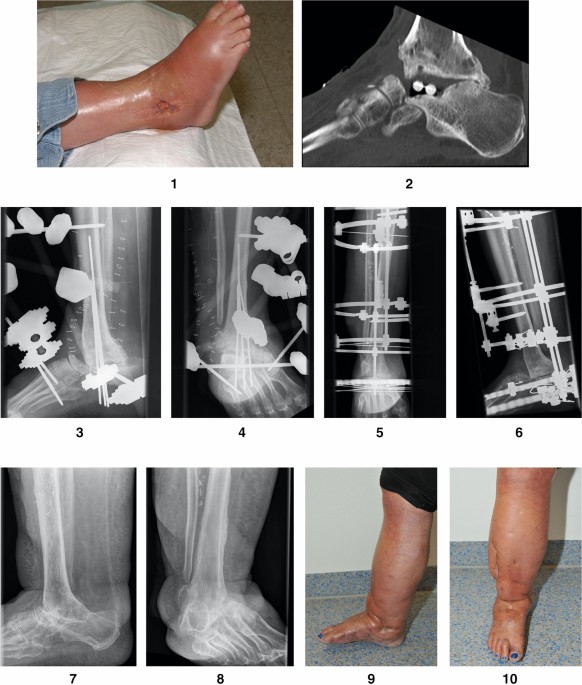 Tibiocalcaneal arthrodesis using the Ilizarov fixator in compromised hosts:  an analysis of 19 patients | Archives of Orthopaedic and Trauma Surgery