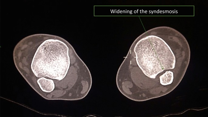 Clinical outcomes of isolated acute instability of the syndesmosis treated  with arthroscopy and percutaneous suture-button fixation