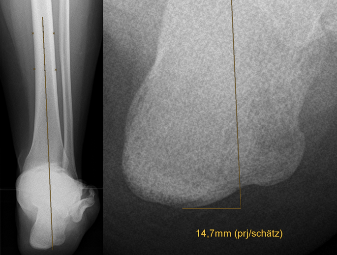 X-ray image of calcaneus. stock image. Image of foot - 53838393