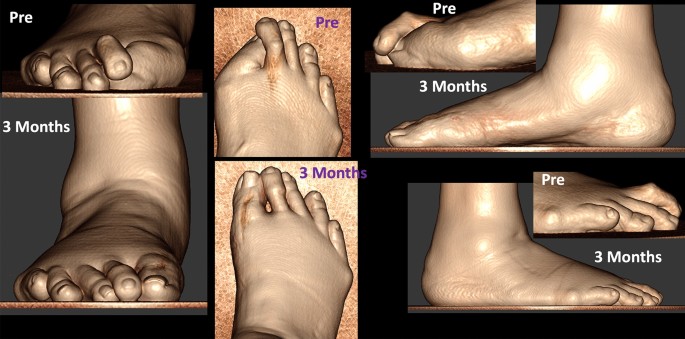 Flexor tenodesis procedure in the treatment of lesser toe deformities |  Archives of Orthopaedic and Trauma Surgery