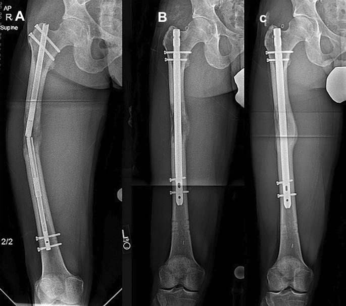 Outcomes of Distal 1/3rd Fracture Shaft Femur, Fixed with Retrograde Intra  Medulary Nailing: A Short-Term Study|crimson publishers.com