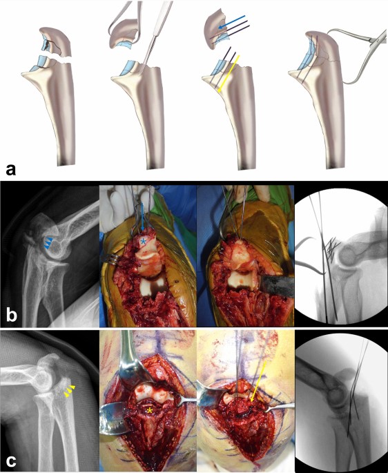 Outcomes of embedded rafting k-wire technique for intermediate articular  fragment fixation in comminuted olecranon fractures | Archives of  Orthopaedic and Trauma Surgery