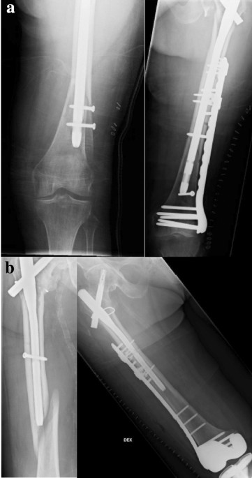 Distal femur AO type A fractures – Surgical options, techniques, results  and complications – Trauma International